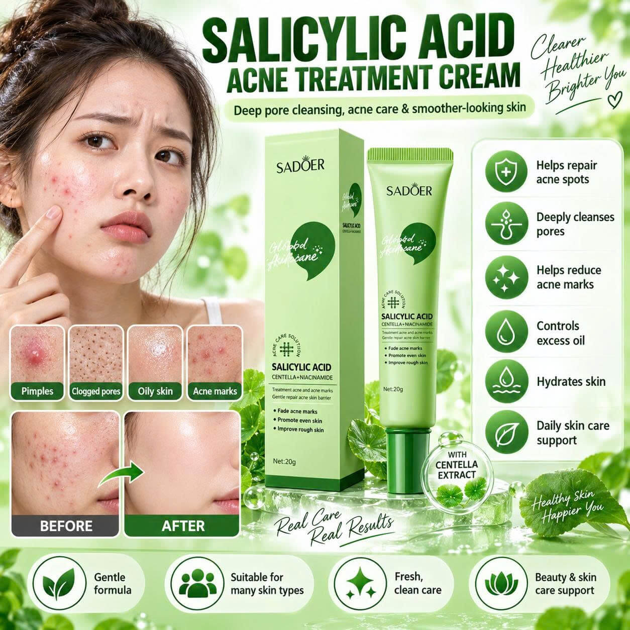 Salicylic Acid Acne Treatment Face Cream