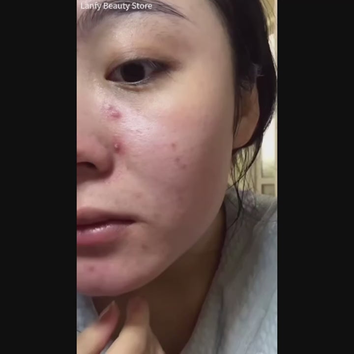 Inflamed Acne – Hidden Acne – Oily Skin – Clogged Pores? Salicylic Acid Supports Pore Cleansing, Oil Control & Smoother-Looking Skin